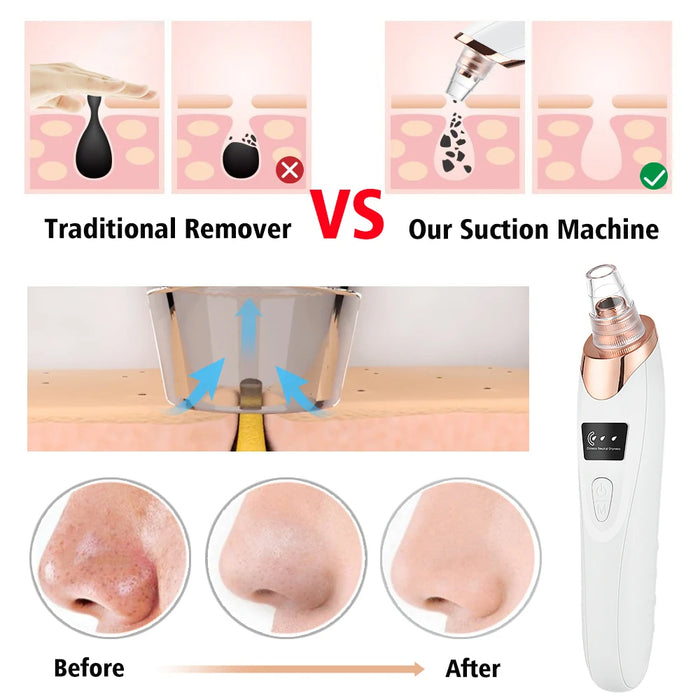 Adkartz™ Vacuum Blackhead Remover