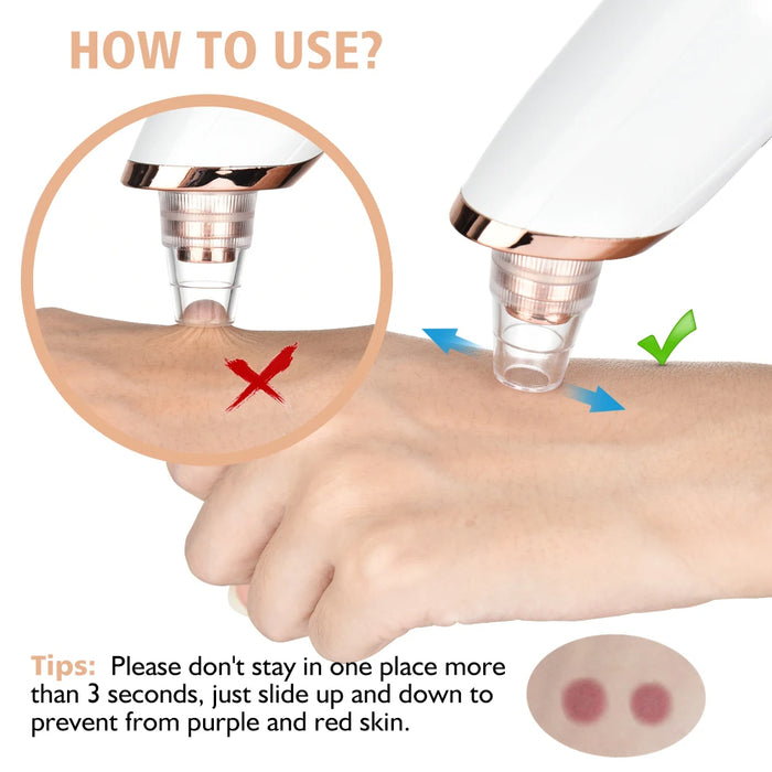 Adkartz™ Vacuum Blackhead Remover