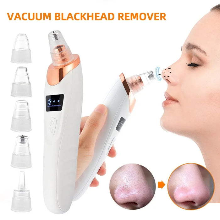 Adkartz™ Vacuum Blackhead Remover